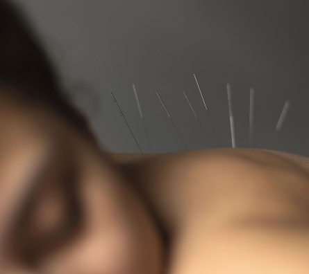 close-up-patient-acupuncture-procedure